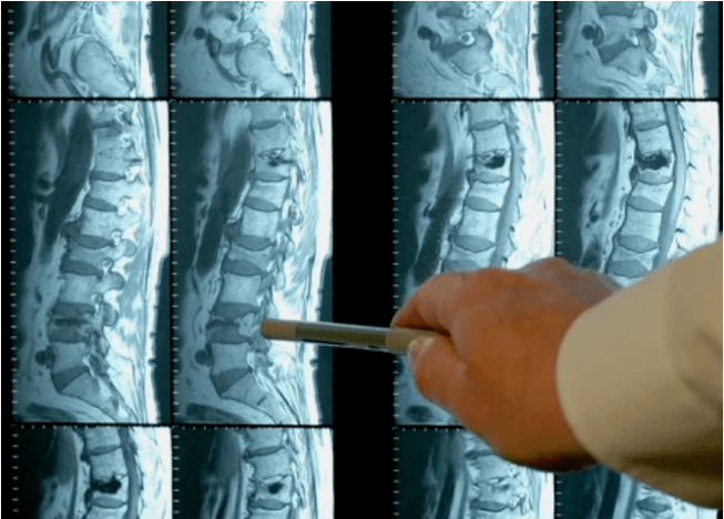 Sorte osteohondroze u kralježnici