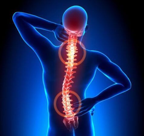 Osteohondroza kralježnice