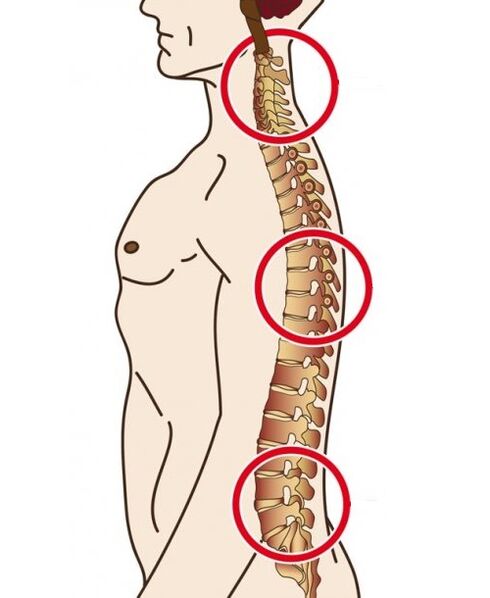 Spinalni odjeli u kojima se javlja osteohondroza