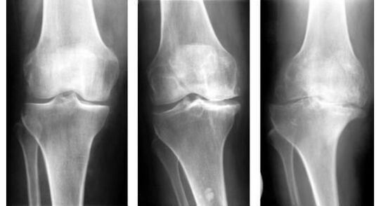 Obvezna dijagnostička mjera pri identificiranju artroze koljena je rendgenska slika