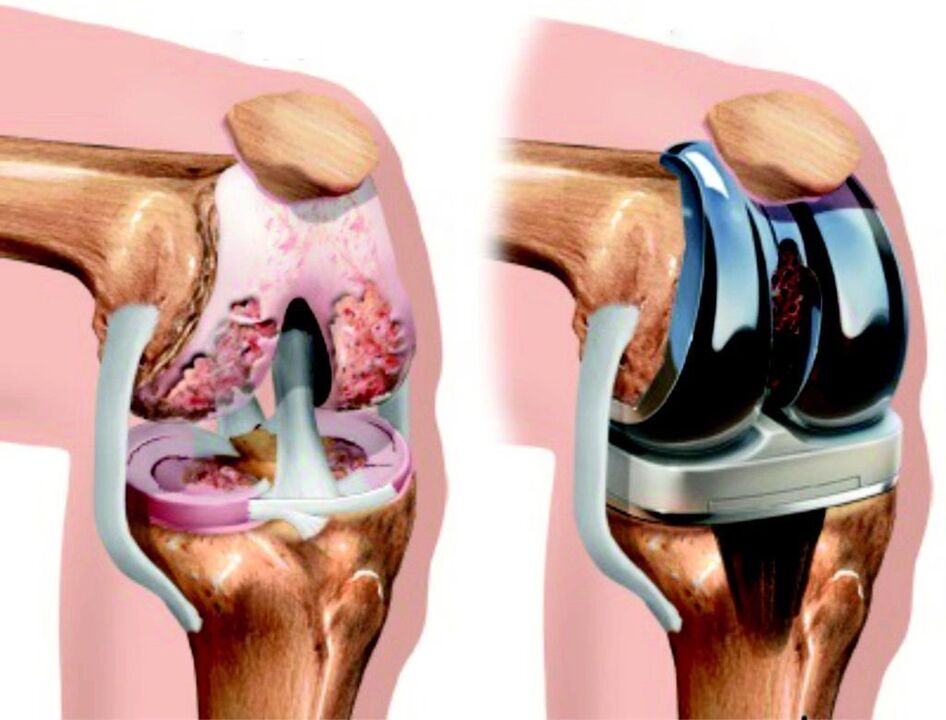 U slučaju potpunog oštećenja zgloba koljena artrozom, on se može obnoviti endoprostetikom