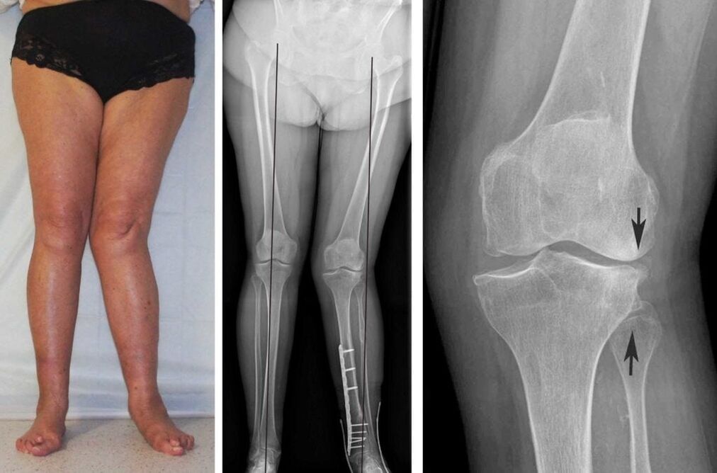 Uznapredovala artroza zglobova koljena jasno je vidljiva vizualno čak i bez rendgenskih zraka